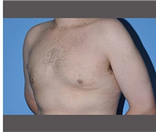 Male Breast Reduction After Photo by Robert Wilcox, MD; Plano, TX - Case 30132