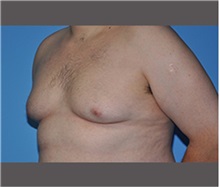 Male Breast Reduction Before Photo by Robert Wilcox, MD; Plano, TX - Case 30132