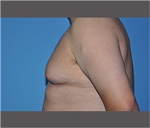 Male Breast Reduction Before Photo by Robert Wilcox, MD; Plano, TX - Case 30132