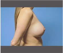 Breast Augmentation After Photo by Robert Wilcox, MD; Plano, TX - Case 30134