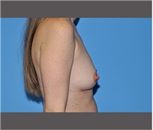 Breast Augmentation Before Photo by Robert Wilcox, MD; Plano, TX - Case 30134