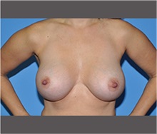 Breast Augmentation After Photo by Robert Wilcox, MD; Plano, TX - Case 30138