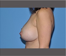 Breast Augmentation After Photo by Robert Wilcox, MD; Plano, TX - Case 30138