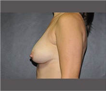Breast Augmentation Before Photo by Robert Wilcox, MD; Plano, TX - Case 30138