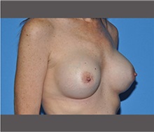 Breast Augmentation After Photo by Robert Wilcox, MD; Plano, TX - Case 30139