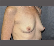 Breast Augmentation Before Photo by Robert Wilcox, MD; Plano, TX - Case 30139