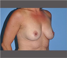 Breast Augmentation Before Photo by Robert Wilcox, MD; Plano, TX - Case 30142
