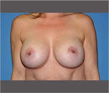 Breast Augmentation After Photo by Robert Wilcox, MD; Plano, TX - Case 30142