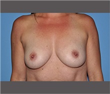Breast Augmentation Before Photo by Robert Wilcox, MD; Plano, TX - Case 30142