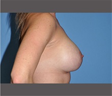 Breast Augmentation After Photo by Robert Wilcox, MD; Plano, TX - Case 30142