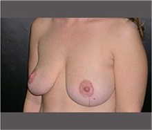 Breast Lift After Photo by Robert Wilcox, MD; Plano, TX - Case 30145