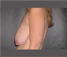 Breast Lift Before Photo by Robert Wilcox, MD; Plano, TX - Case 30145