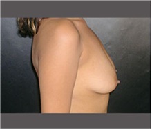 Breast Lift Before Photo by Robert Wilcox, MD; Plano, TX - Case 30146