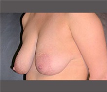 Breast Lift Before Photo by Robert Wilcox, MD; Plano, TX - Case 30150