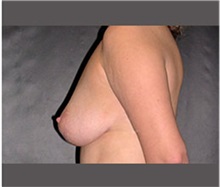 Breast Lift After Photo by Robert Wilcox, MD; Plano, TX - Case 30150