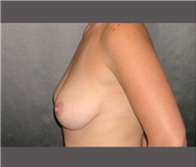 Breast Lift Before Photo by Robert Wilcox, MD; Plano, TX - Case 30151