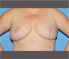 Breast Reduction After Photo by Robert Wilcox, MD; Plano, TX - Case 30152