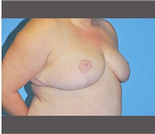 Breast Reduction After Photo by Robert Wilcox, MD; Plano, TX - Case 30152