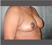 Breast Reduction After Photo by Robert Wilcox, MD; Plano, TX - Case 30153