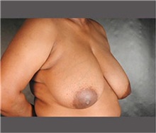 Breast Reduction Before Photo by Robert Wilcox, MD; Plano, TX - Case 30153
