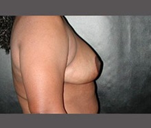 Breast Reduction After Photo by Robert Wilcox, MD; Plano, TX - Case 30153