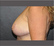 Breast Reduction After Photo by Robert Wilcox, MD; Plano, TX - Case 30155