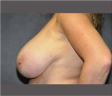 Breast Reduction Before Photo by Robert Wilcox, MD; Plano, TX - Case 30155