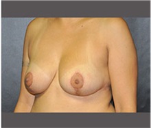Breast Reduction After Photo by Robert Wilcox, MD; Plano, TX - Case 30156