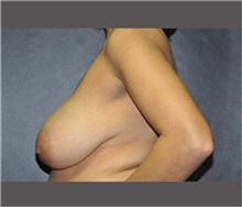 Breast Reduction Before Photo by Robert Wilcox, MD; Plano, TX - Case 30156