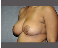 Breast Reduction After Photo by Robert Wilcox, MD; Plano, TX - Case 30157