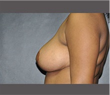 Breast Reduction After Photo by Robert Wilcox, MD; Plano, TX - Case 30157