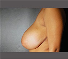 Breast Reduction Before Photo by Robert Wilcox, MD; Plano, TX - Case 30157