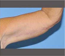 Arm Lift After Photo by Robert Wilcox, MD; Plano, TX - Case 30165