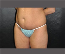 Liposuction Before Photo by Robert Wilcox, MD; Plano, TX - Case 30166