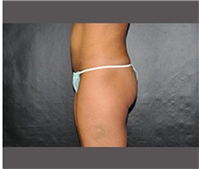 Liposuction After Photo by Robert Wilcox, MD; Plano, TX - Case 30166
