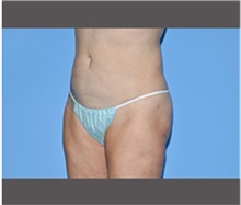 Liposuction After Photo by Robert Wilcox, MD; Plano, TX - Case 30167
