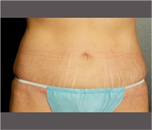 Tummy Tuck After Photo by Robert Wilcox, MD; Plano, TX - Case 30173