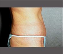 Tummy Tuck After Photo by Robert Wilcox, MD; Plano, TX - Case 30173