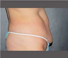 Tummy Tuck Before Photo by Robert Wilcox, MD; Plano, TX - Case 30173