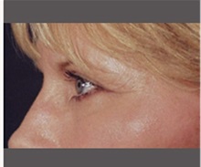 Eyelid Surgery After Photo by Robert Wilcox, MD; Plano, TX - Case 30177