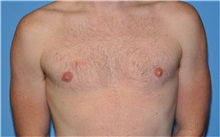 Male Breast Reduction After Photo by Robert Wilcox, MD; Plano, TX - Case 31346