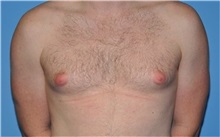 Male Breast Reduction Before Photo by Robert Wilcox, MD; Plano, TX - Case 31346