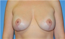 Breast Lift After Photo by Robert Wilcox, MD; Plano, TX - Case 31459