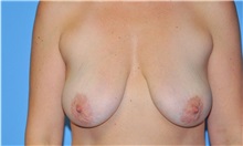 Breast Lift Before Photo by Robert Wilcox, MD; Plano, TX - Case 31459