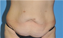 Tummy Tuck Before Photo by Robert Wilcox, MD; Plano, TX - Case 31463