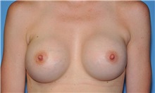 Breast Augmentation After Photo by Robert Wilcox, MD; Plano, TX - Case 31827