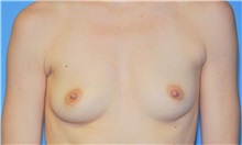 Breast Augmentation Before Photo by Robert Wilcox, MD; Plano, TX - Case 31827