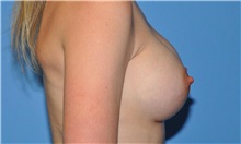 Breast Augmentation After Photo by Robert Wilcox, MD; Plano, TX - Case 31827