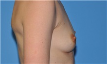 Breast Augmentation Before Photo by Robert Wilcox, MD; Plano, TX - Case 31827