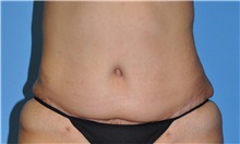 Tummy Tuck After Photo by Robert Wilcox, MD; Plano, TX - Case 31828